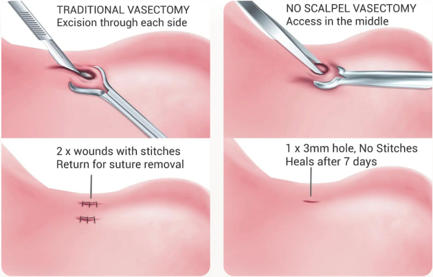 No Scalpel technique