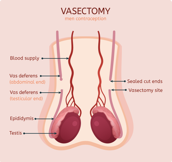 What is Vasectomy