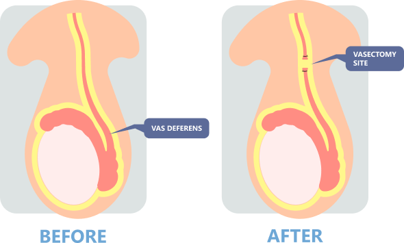 how Vasectomy Works